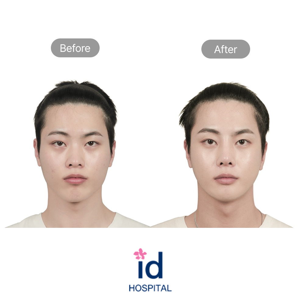 Male Rhinoplasty Before and After Result at ID Hospital