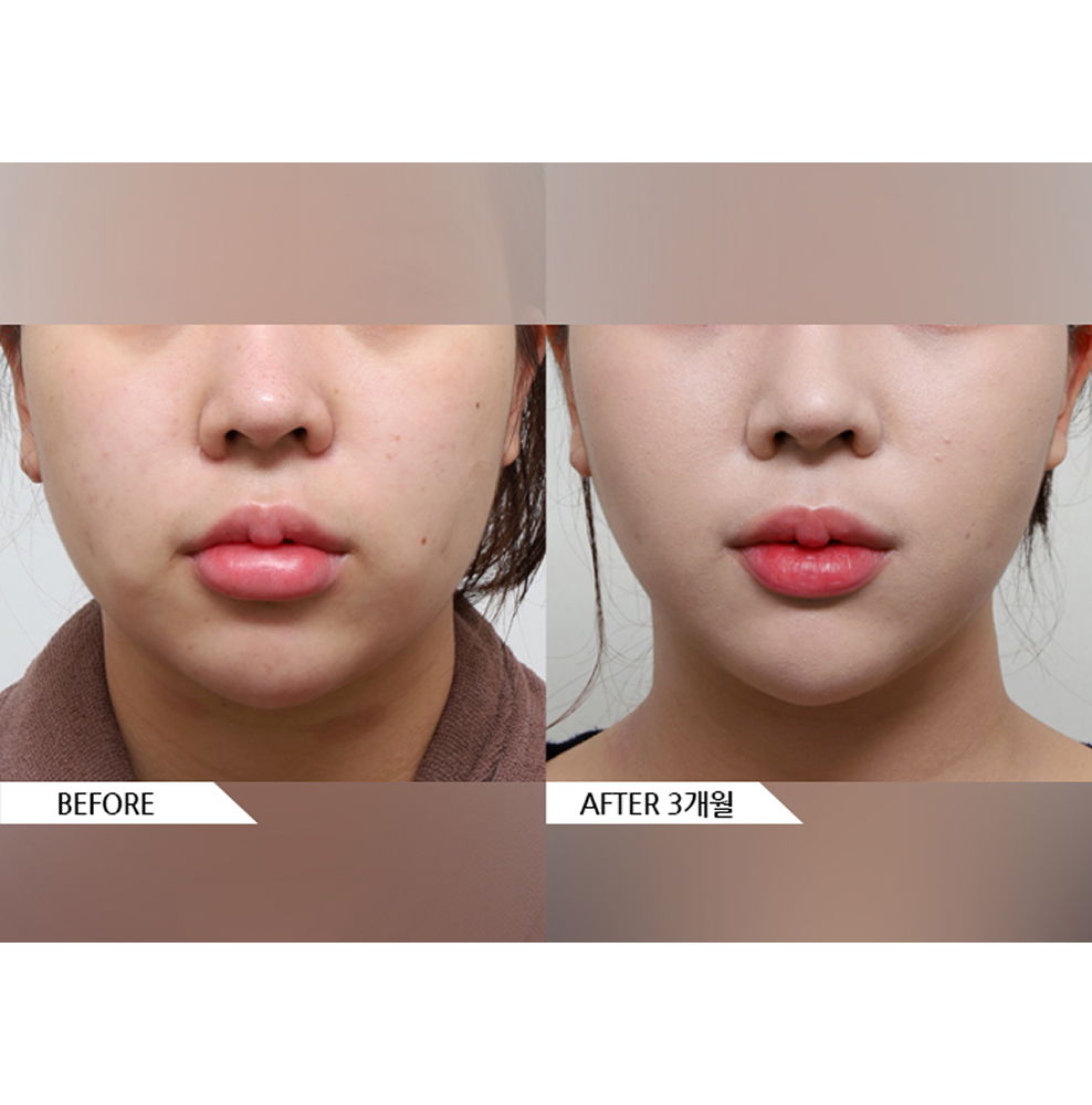 Before and after full face liposuction showing a slimmer facial contour and improved V-line from the front view 3 months after treatment in Korea