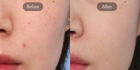 Skin regeneration results for sagging skin using Rejuran healer, improving skin texture, elasticity, and overall skin quality