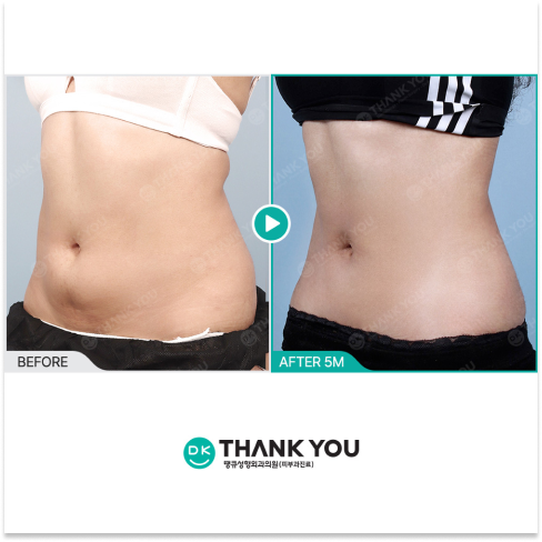Plastic Surgery Recovery Timeline at 5 Months Showing Refined Results and Late Stage Healing Progress