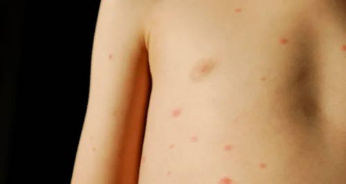 Child with chickenpox showing a scattered red rash on their chest and arm 