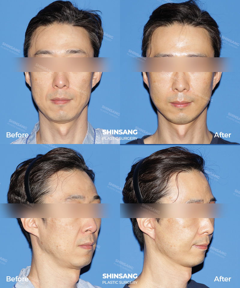 Mini Facelift Result Review At Sinsang Plastic Surgery In Korea