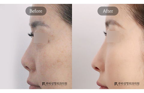 Revision rhinoplasty correcting short nose with enhanced nasal bridge and tip projection showing final 1 year result in Korea