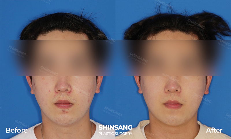 Scar Treatment Before And After Result At Sinsang Plastic Surgery In Korea