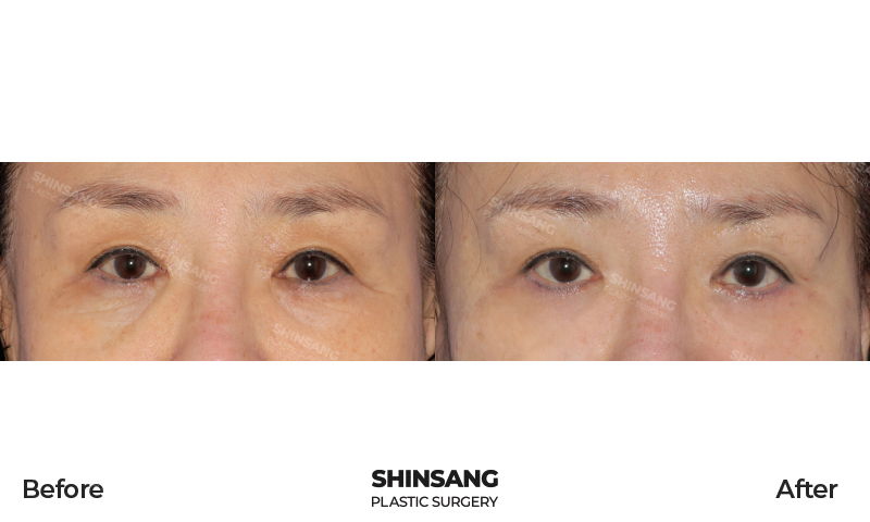 Lower Blepharoplasty With Under Eye Fat Repositioning Result At Sinsang Plastic Surgery In Korea