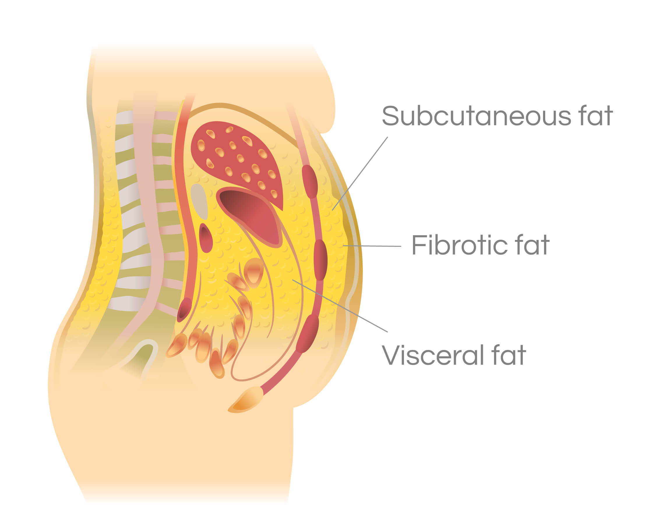 Diagram showing soft, fibrotic, and visceral fat in the human body.