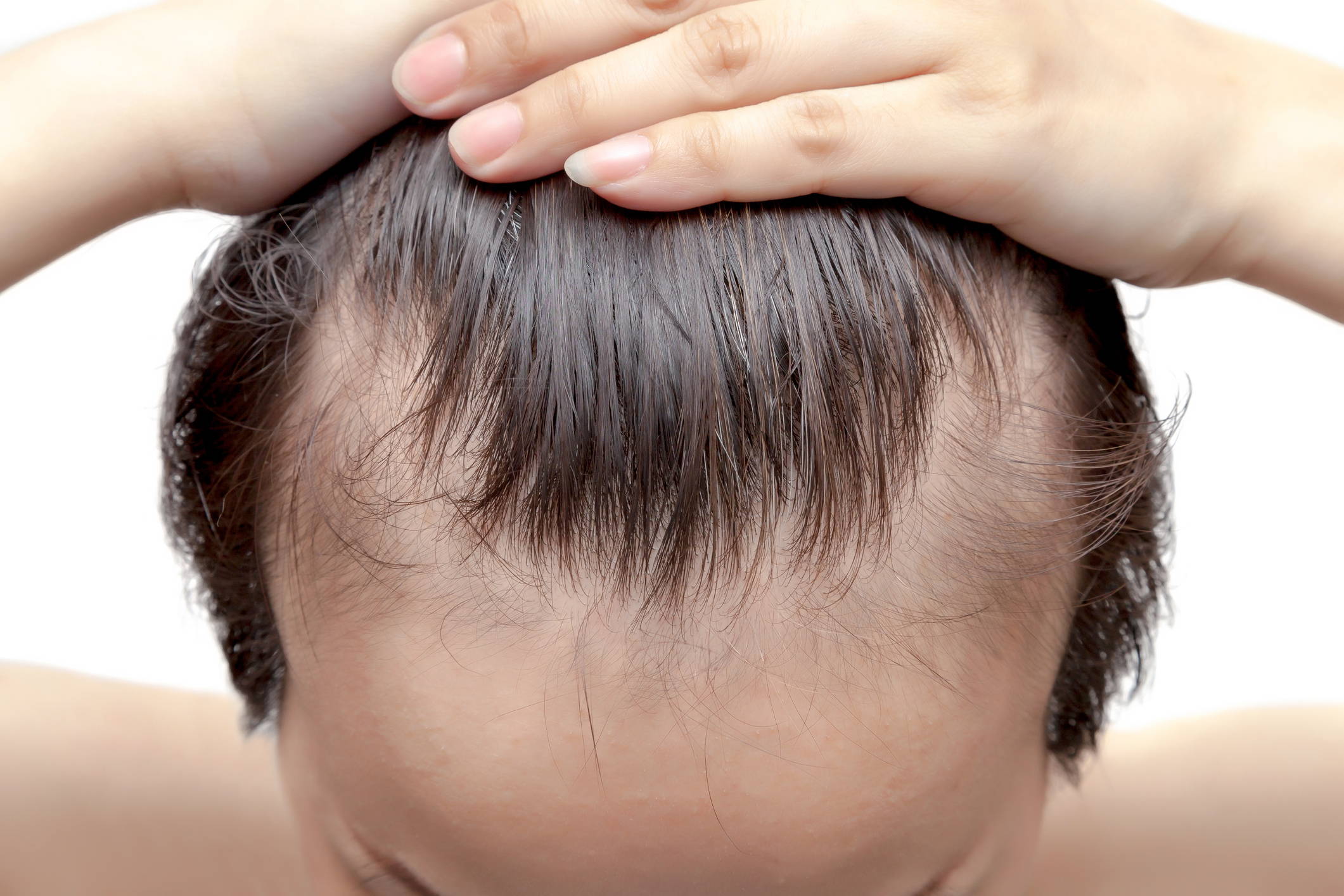 How to Fix a Widow's Peak – DS Healthcare Group