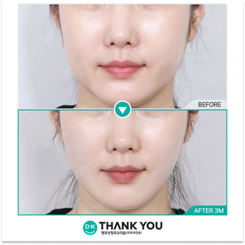 Non-surgical full face lifting results for sagging skin using Thermage 600 shots with natural tightening and smoother skin appearance