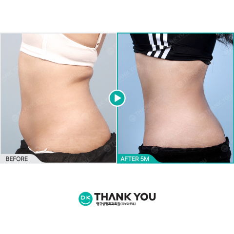 Abdominal Liposuction Before And After Results Showing Body Fat Reduction At 5 Months In Korea