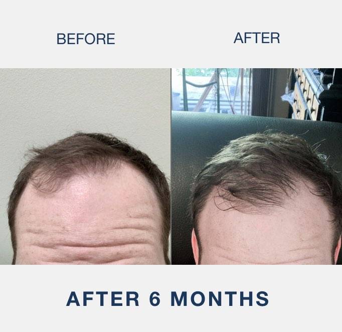 laser cap results from man with receding hairline
