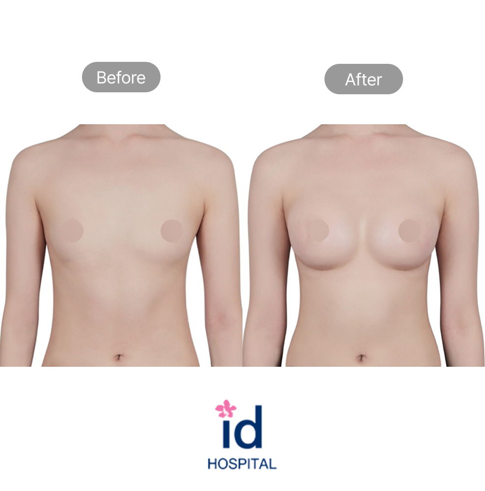 Breast Augmentation Surgery Before and After Result at ID Hospital