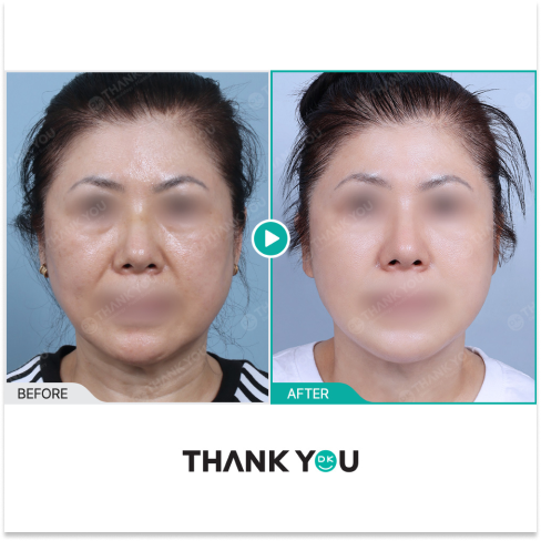 Dual lifting results for sagging skin using HIFU Shurink and InMode RF, enhancing skin tightening and facial rejuvenation