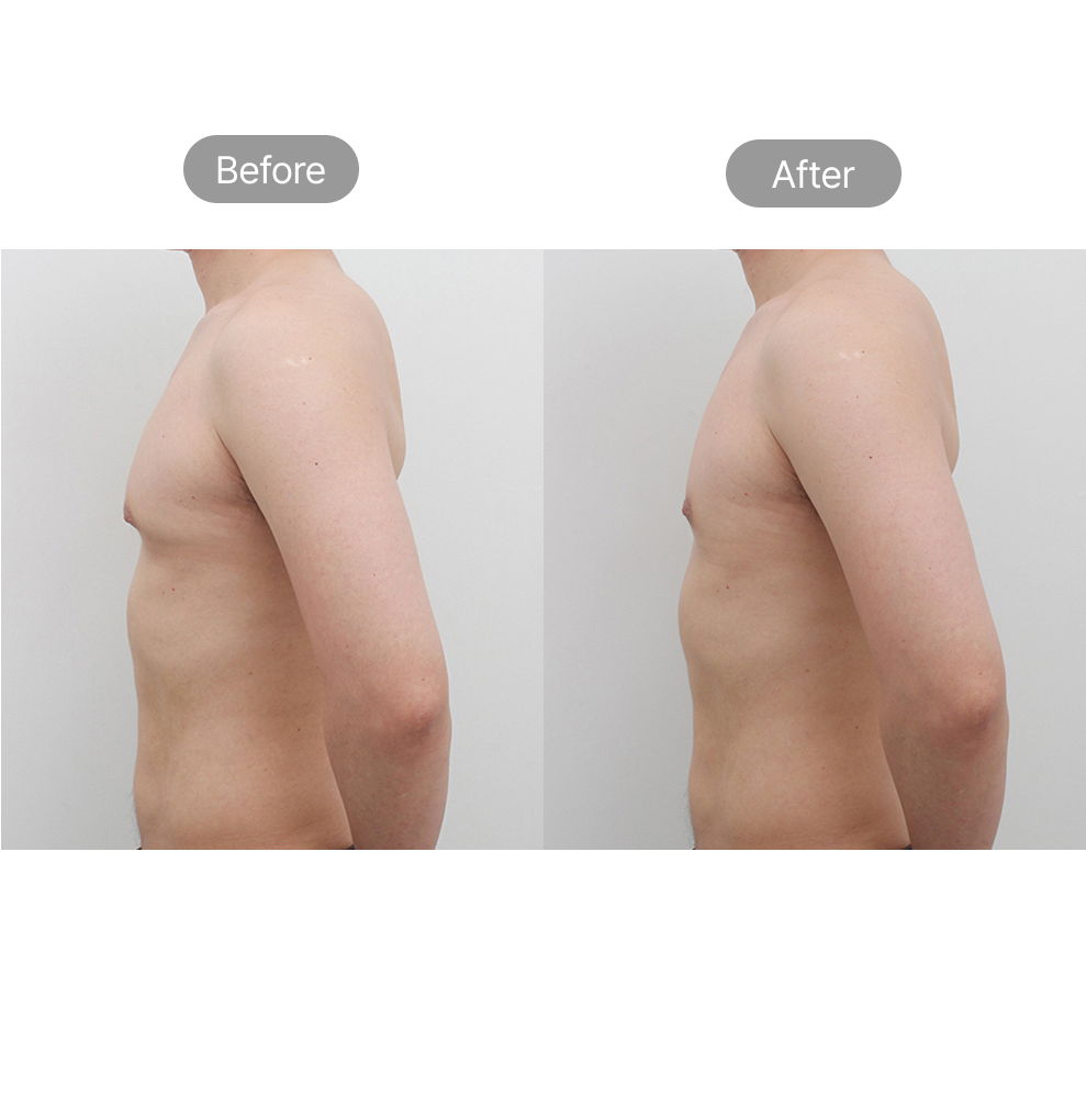 Gynecomastia surgery before and after side view results at Fresh Dr. Hong in Korea