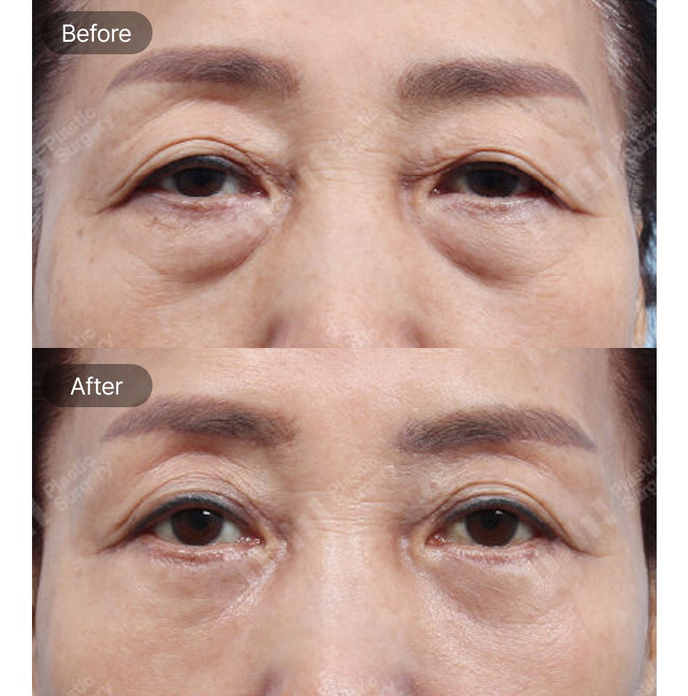 Brow Lift Surgery Before and After Results at 1MM Plastic Surgery in Korea for Brighter and More Youthful Eyes