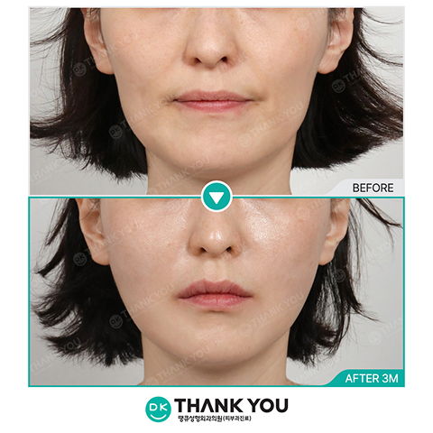Plastic Surgery Korea Face Filler Before and After for Smile Lines and Cheek Volume Restoration