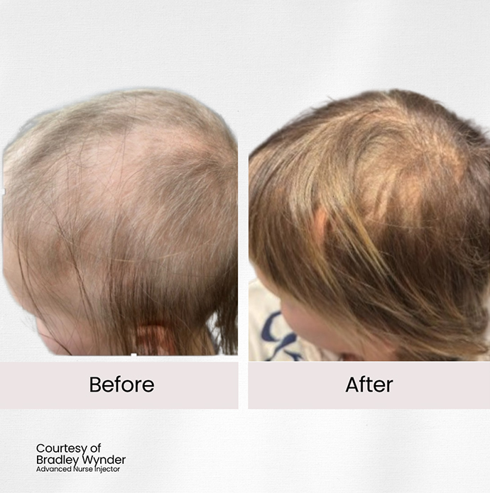 hair restoration after cancer treatment