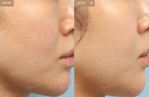 Before And After Review Image Of Juvelook Treatment At 1mm Plastic Surgery Clinic In Korea