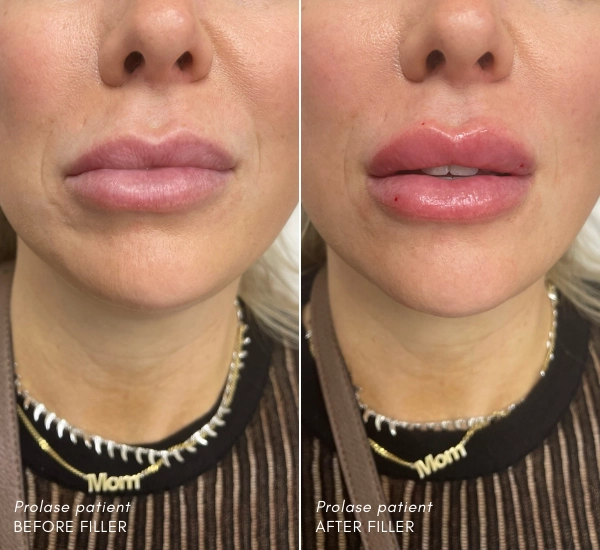 Prolase Patient before and after filler with Enesae Keshishian RN