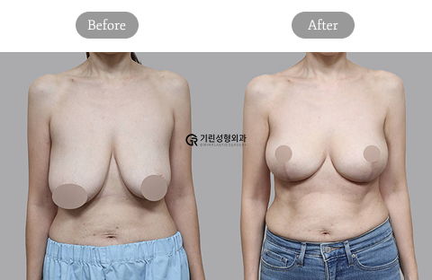 Mommy Makeover Korea Breast Lift Before and After Results at Girin Plastic Surgery Clinic
