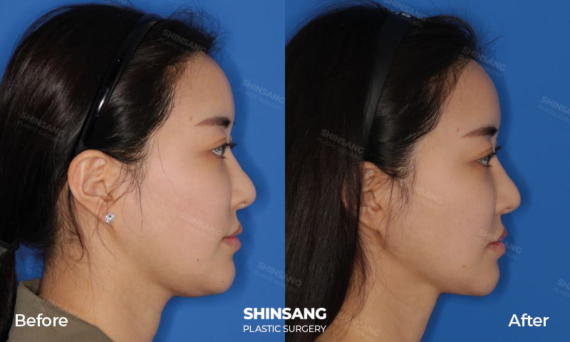 Pixel Injection With Tension Lifting Face Lifting Result Review At Sinsang Plastic Surgery In Korea