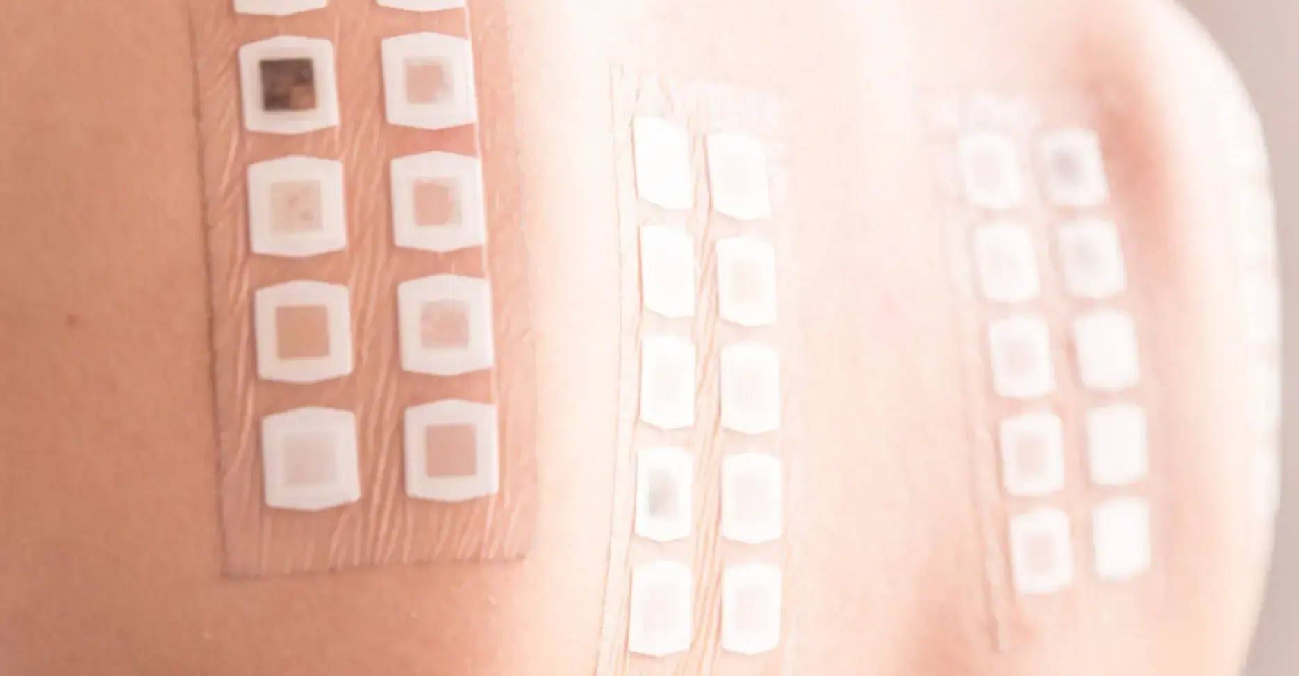 Child having a patch test for contact allergy – there are 3 grids of small white circles taped to their back