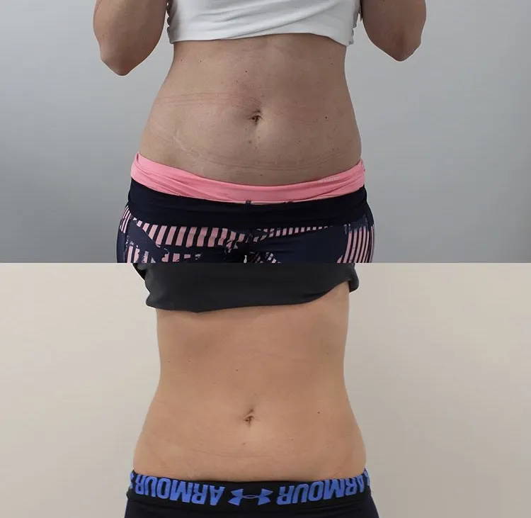 Body Contouring