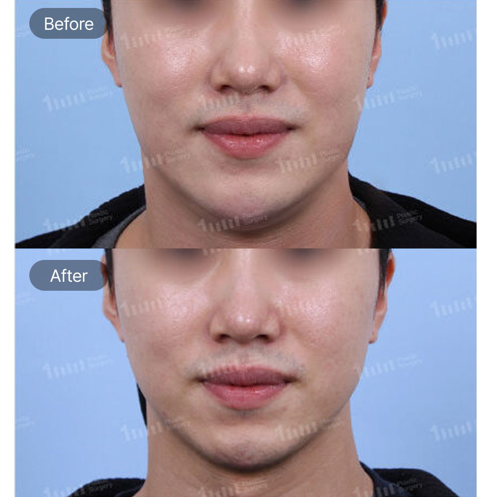 Contouring Injection Before and After Results at 1MM Plastic Surgery in Korea for a Slimmer and More Defined Jawline