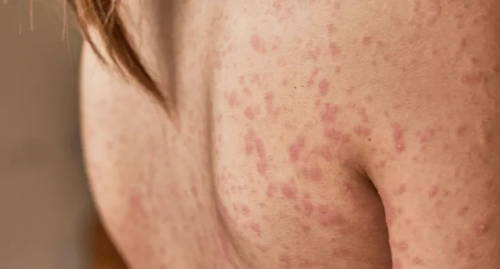 Le dos et le bras de l’enfant sont couverts d’une éruption cutanée causée par une réaction allergique aux antibiotiques