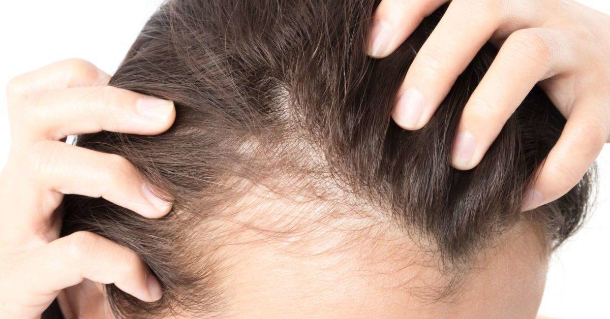 Hair Thinning On One Side of Head - Causes & Solutions – DS