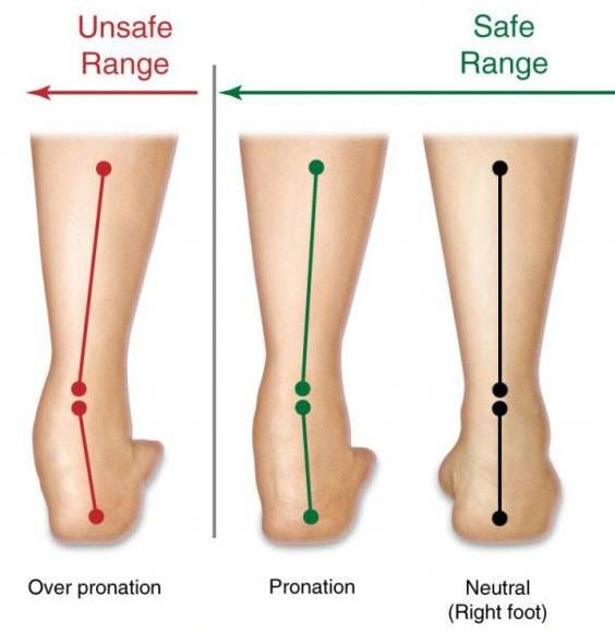 ranges of plantar fasciitis