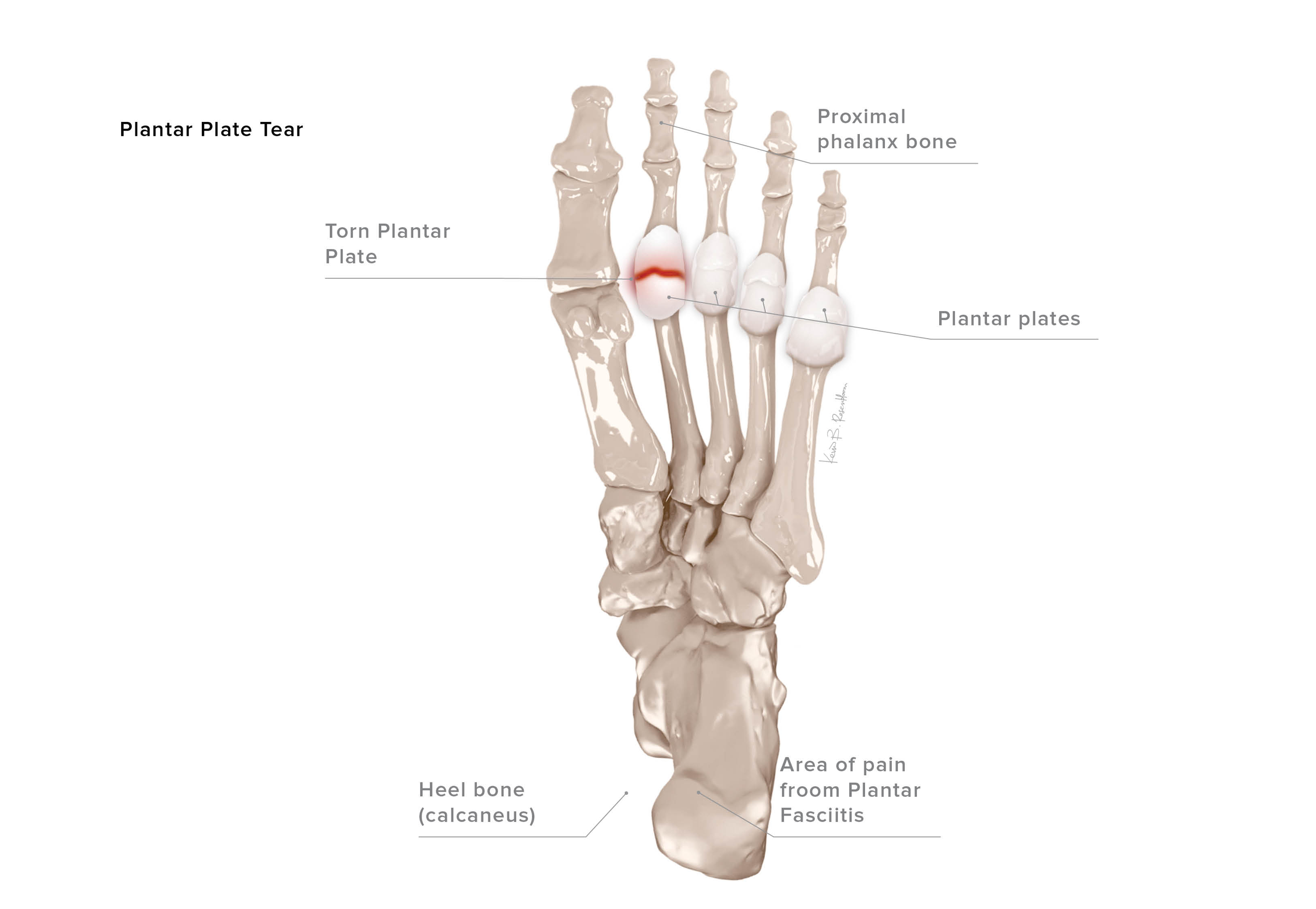 Plantar Plate Tear KevinRoot Medical