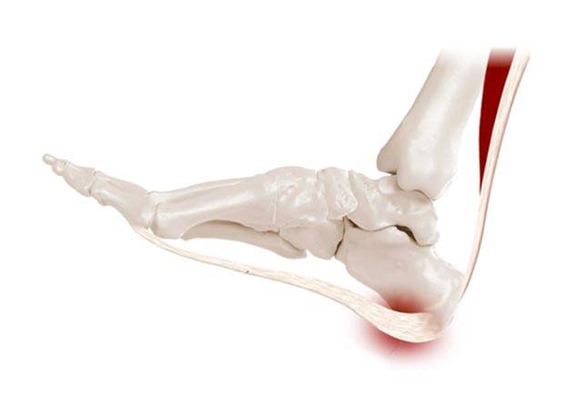 Plantar Fasciitis