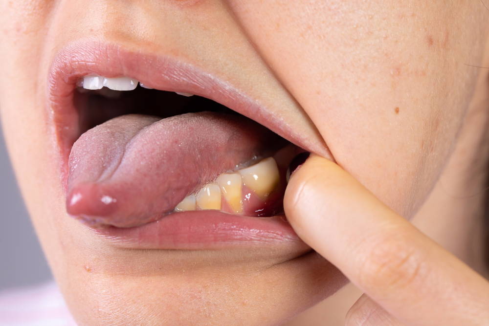 a closeup of a mouth with a finger pulling the cheek away to expose yellowing teeth. The tongue is stuck out. 