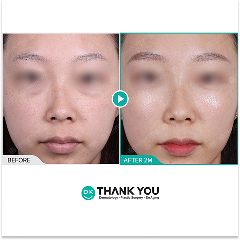 Rejuran Healer for Korean Summer Skin Treatments Focused on Skin Barrier Repair, Hydration, and Post-UV Recovery