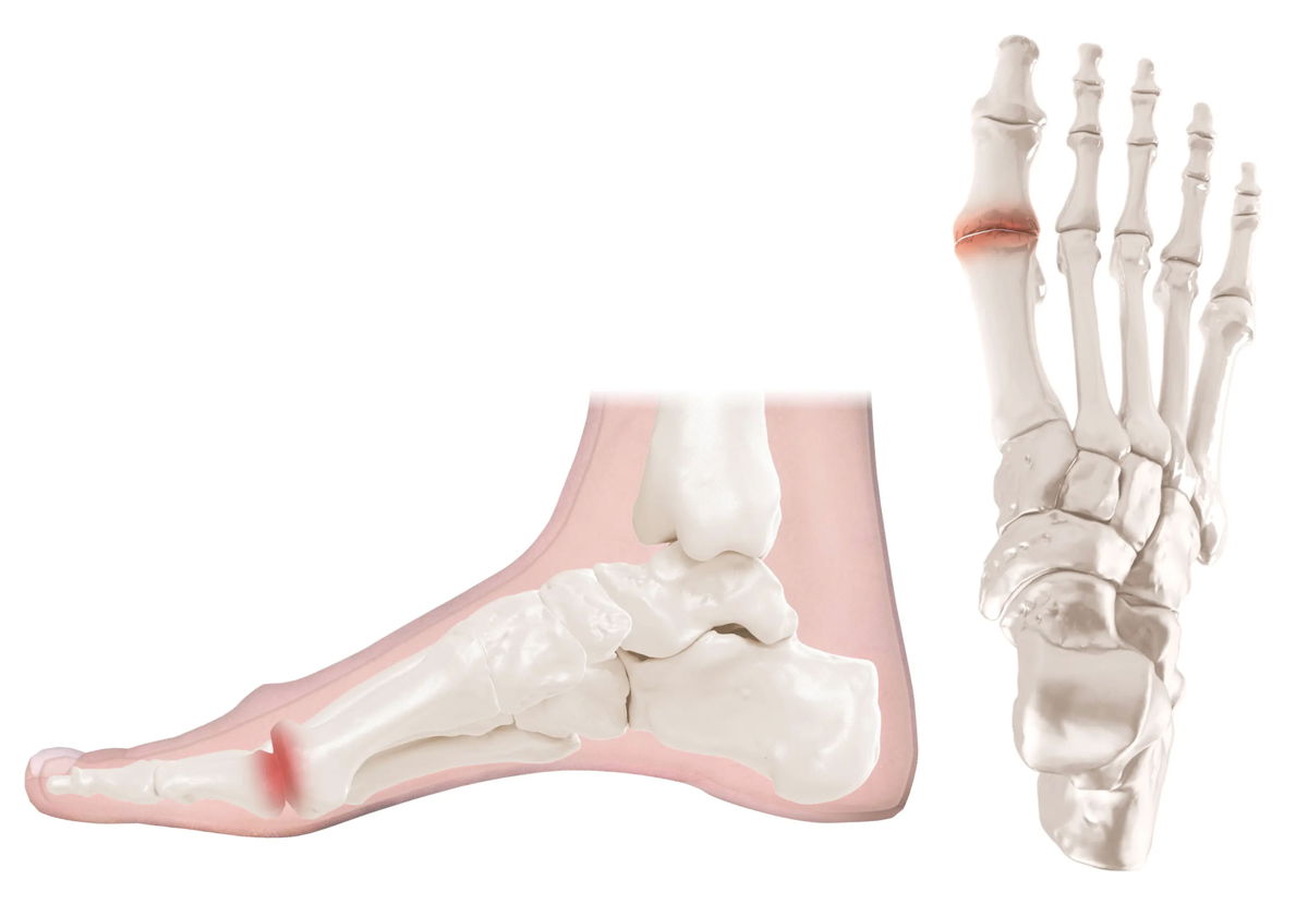Hallux Limitus — first MPJ anatomy and degeneration pathway