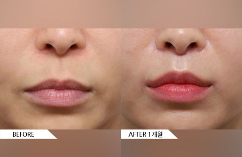 Corner lip lift and philtrum reduction before and after results creating a more youthful smile appearance