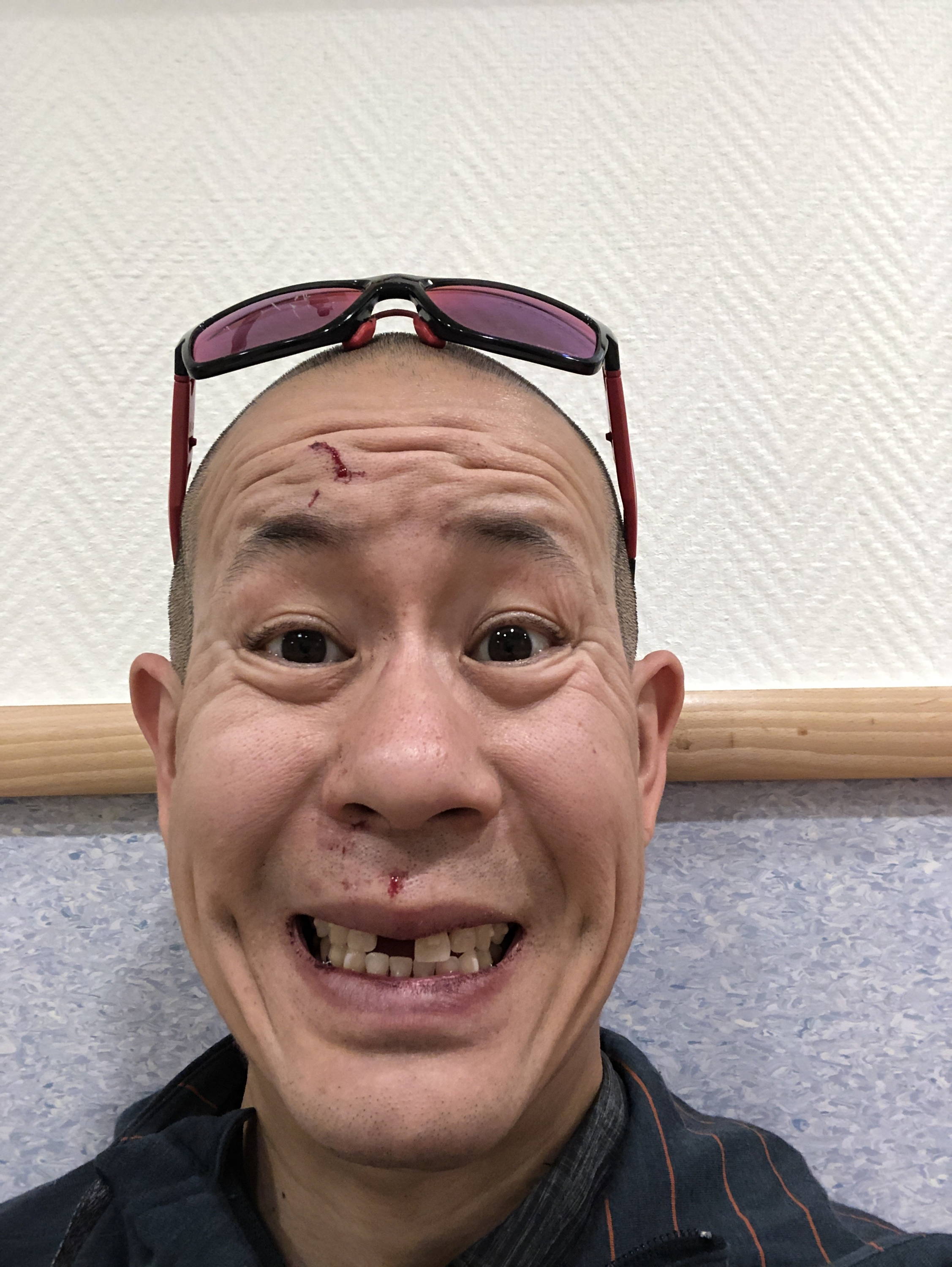 James Huang  with a cut on his forehead and a missing front tooth