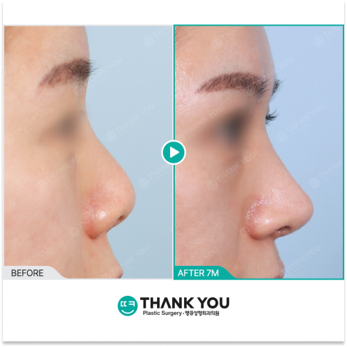 Revision rhinoplasty 7 months after surgery showing stabilized nasal shape and refined profile result in Korea