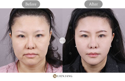 3D Ultrasound-Guided Face Lift Using Threads Before and After 1 Month – Jawline Thread Lift in Korea by Jivaka Beauty