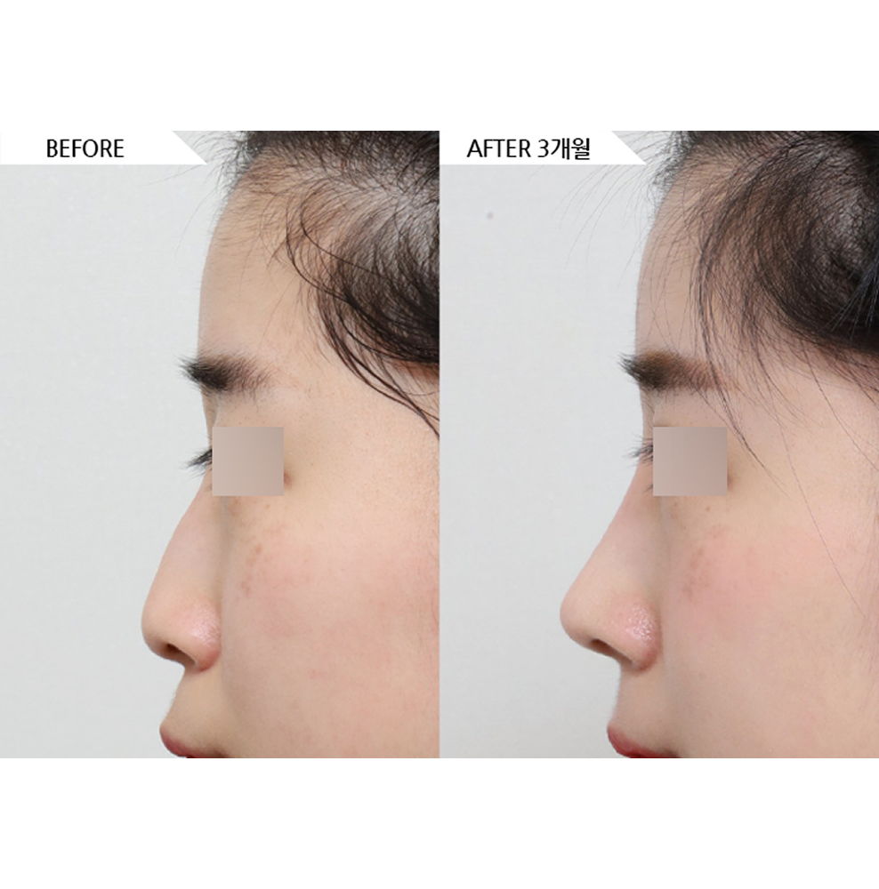 Before and after results of triple line rhinoplasty showing a more defined and natural nose line and profile in Korea