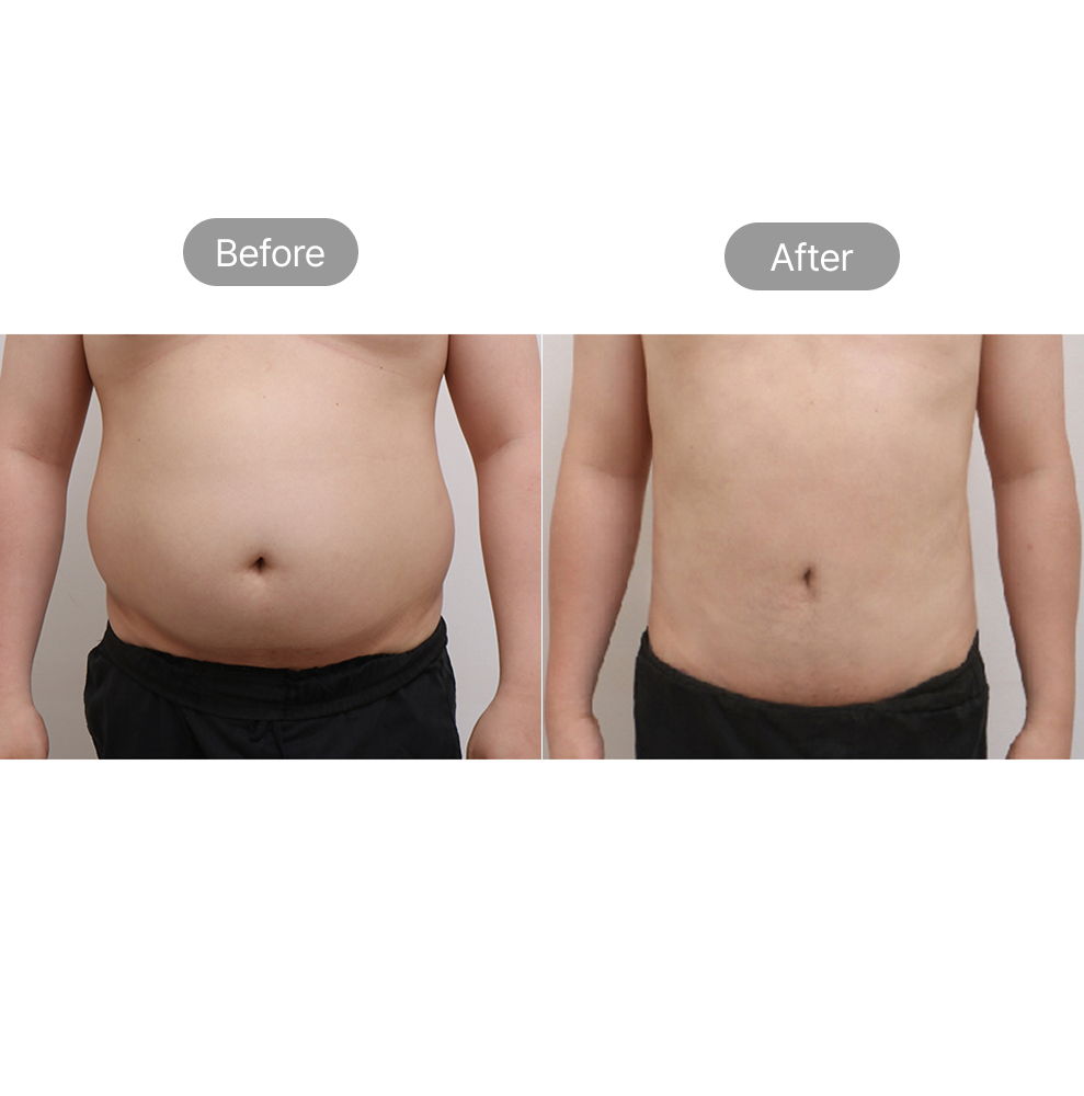 Abdominal liposuction before and after results for a slimmer waistline in Korea