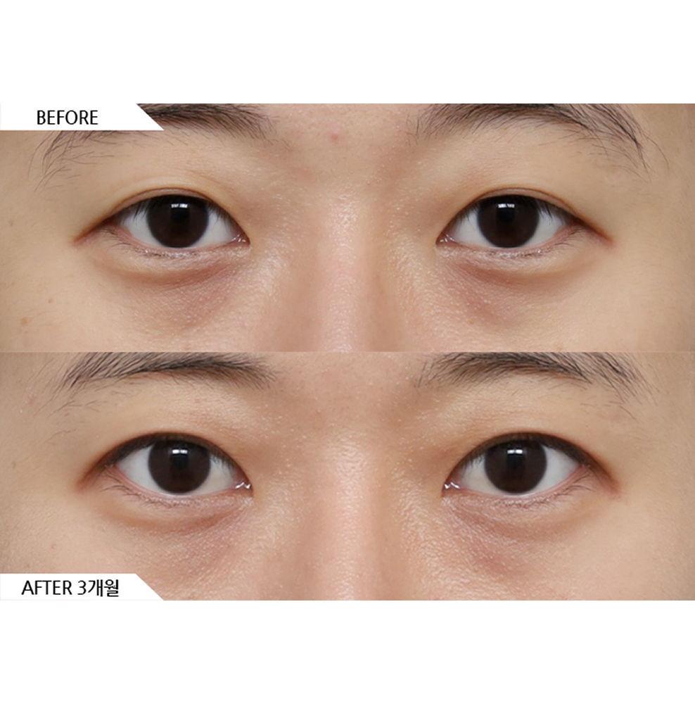 Before and after results of eye revision surgery showing improved eye opening and more natural eye shape in Korea
