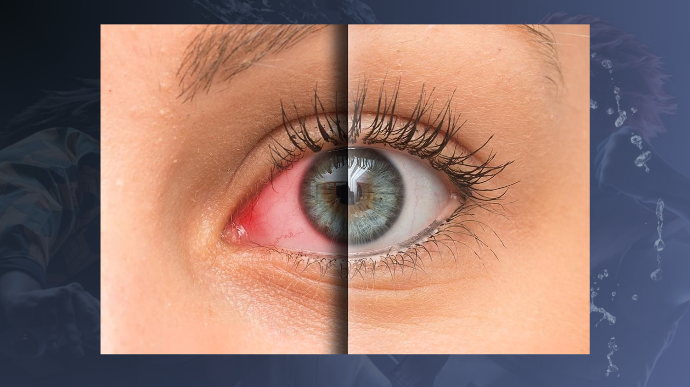 Close-up of eye showing contact lens irritation, with one side red and inflamed and the other clear, illustrating signs it is time to remove cosplay contact lenses.