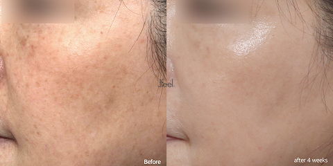 Before and after results of Korean skin treatments improving acne and pigmentation through personalized facial treatment and clinical skin care solutions