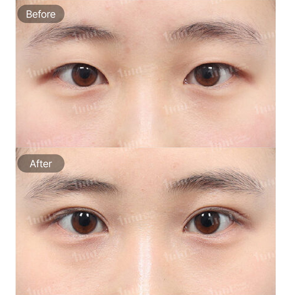Incisional Double Eyelid Surgery and Upper Epicanthoplasty Before and After Results at 1MM Plastic Surgery in Korea