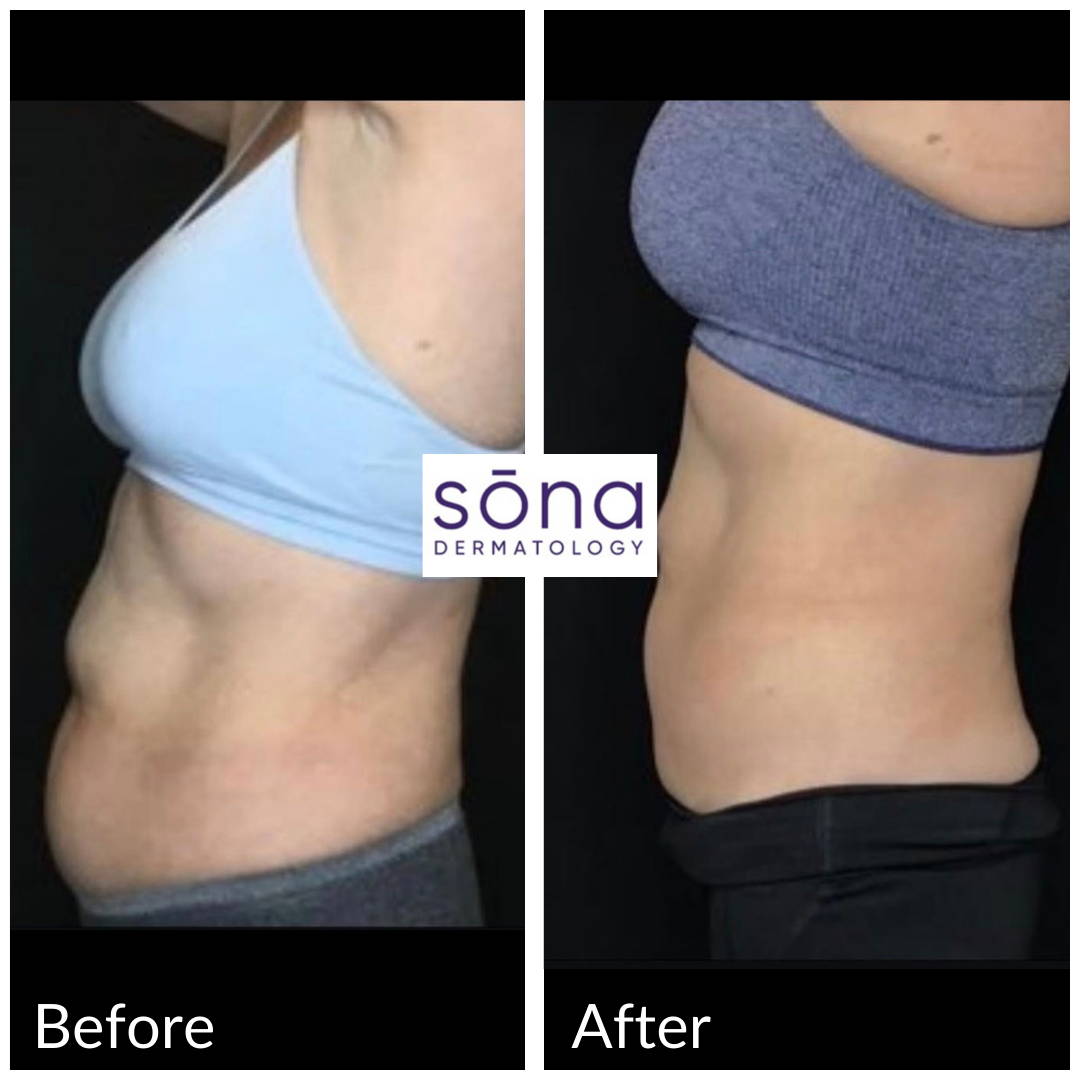 Sona CoolSculpting Before & After