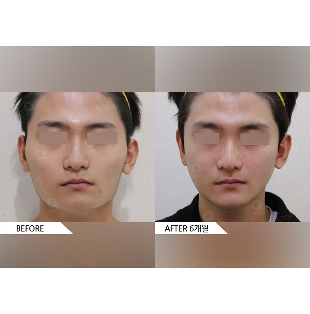 Before and after results of male facial contouring surgery including jaw reduction, cheekbone reduction, and chin surgery for a more defined and balanced masculine face in Korea