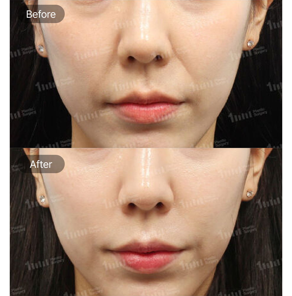 Juvelook Volume Before and After Results at 1MM Plastic Surgery in Korea for Natural Facial Volume and Skin Rejuvenation