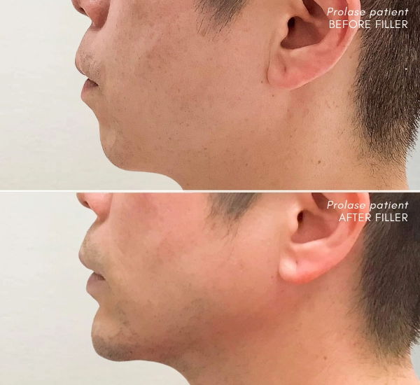 Prolase Patient before and after 6 syringes of Juvederm Voluma in chin and cheeks over 1 year Laila Khalaj