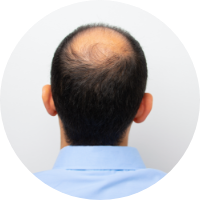 back of mans head to represent who is at risk of hair loss